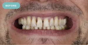 Realistic Bridge Dental Before