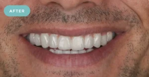 Realistic Bridge Dental after