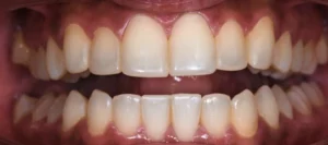 Realistic Invisalign After
