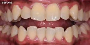 Realistic Invisalign Before