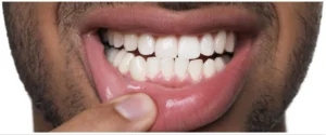 Sensitivity After Hygienist