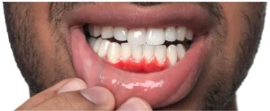 Sensitivity Before Hygienist