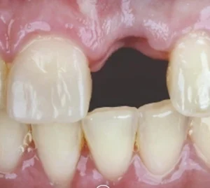 Single Dental