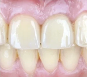 Single Dental Implants