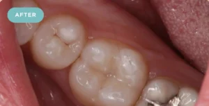 Tooth Filling After