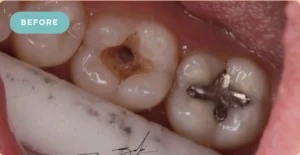 Tooth Filling Before