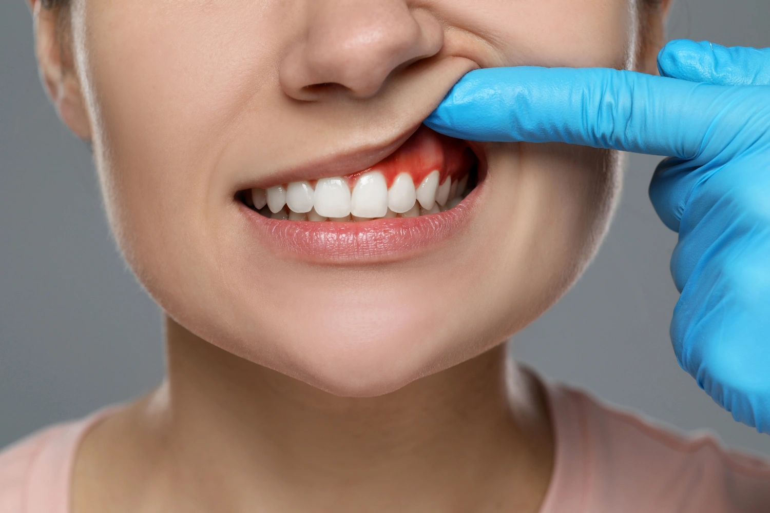 Veneers Before After: Realistic Results, Recovery & What to Expect