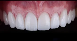 whitening