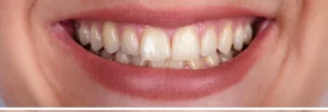 tooth
