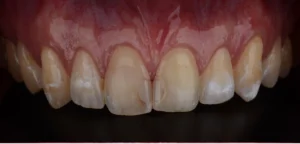 whitening