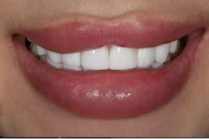 tooth whitening after