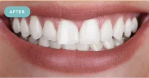 tooth whitening after