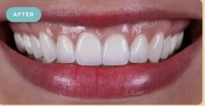 tooth whitening after img