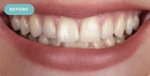tooth whitening before