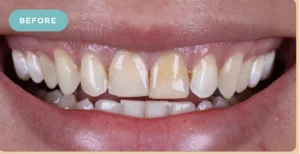 tooth whitening before