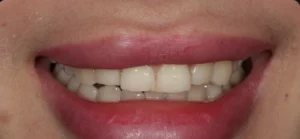 tooth whitening before