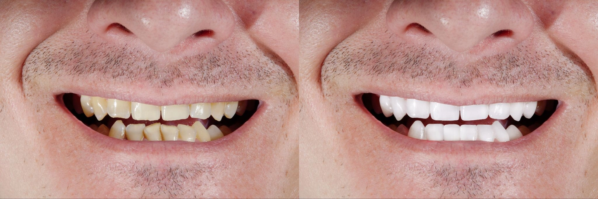 tooth whitening img