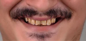 veneers