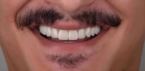 veneers