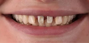 veneers
