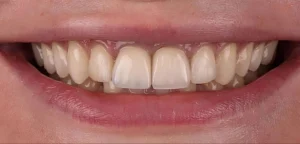 veneers