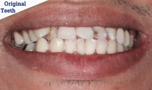veneers