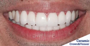 veneers