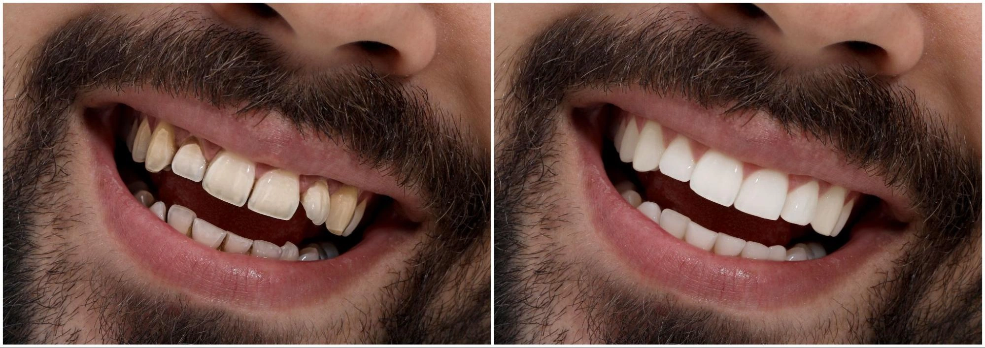 veneer