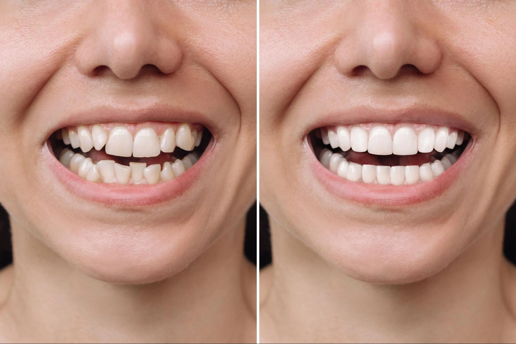 veneer
