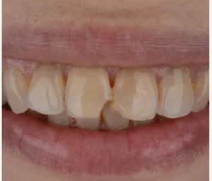 veneer