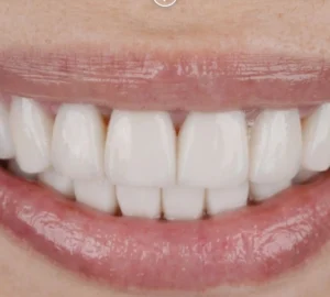 veneer