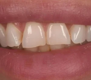 veneer