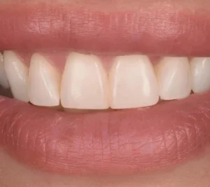 veneer