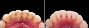 whitening